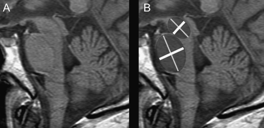 RoyCLinMD's tweet photo. #Hummingbird or not, have you found it difficult to call in #PSP? A simple measurement of midbrain 9.35 mm and midbrain/pons 0.52 might help clinicians to further decide. https://t.co/mBrbSRhj98 @GreenJournal @PSP_CBD_MSA @CurePSP #MovDisord #NeuroTwitter #MedTwitter https://t.co/74SmJJrf8F