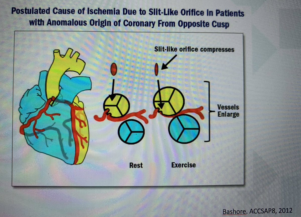 ‘Anomalous coronary artery from the opposite sinus of valsalva (ACAOS)’ Course can be:- Interarterial- Prepulmonary- Retroaortic - Intraseptal Slides from  @mhd_soud ppt  @DrAnkitKPatel  @AlexShehataMD  @Umair2017  @SanChris999  @KevinShahMD  #ACCFIT  #ACCEarlyCareer  #ACCIC