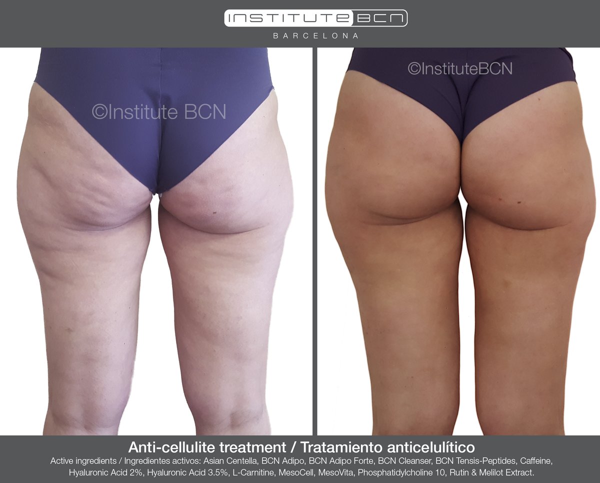 bcnmesotherapy's tweet photo. MesoCell® is the indispensable #cosmetic complement to get optimal results from a professional #aesthetictreatment

MesoCell® es el complemento #cosmético indispensable para obtener resultados óptimos del #tratamientoestético profesional. https://t.co/mzSmAi2agU