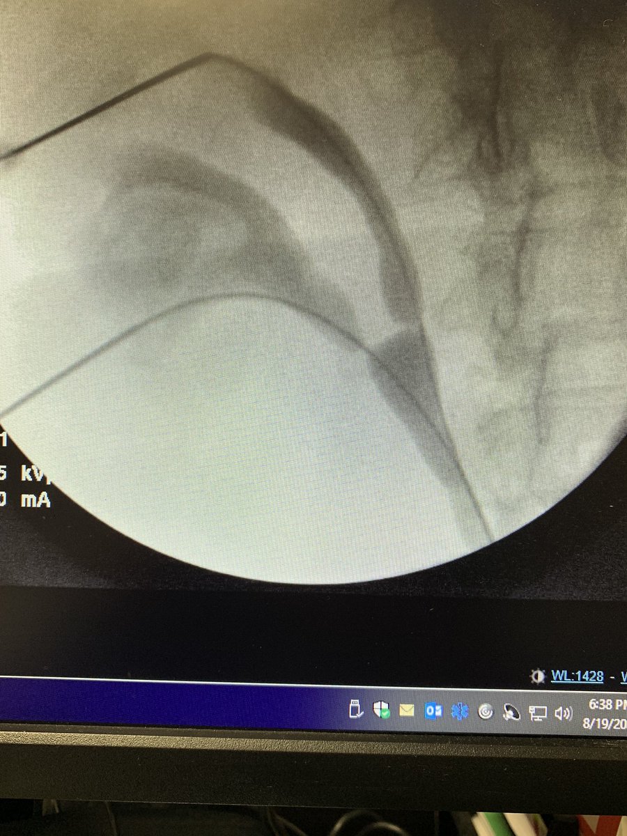William Atallah MD, MPH (@william_atallah) on Twitter photo Duplex collecting system with 2 cm lower pole stone treated with standard 24 fr PCNL and 1.2 cm upper pole stone treated with 16.5 fr mini PCNL. Access obtained in both systems via ultrasound guidance prior to dilation. <a href="/RockDocGoneWild/">Stone Surgeons Gone Wild</a> <a href="/MantuGuptaMD/">Mantu Gupta, M.D.</a> <a href="/JohnathanKhusid/">Johnathan A. Khusid, MD</a> <a href="/AreebaSadiq/">Areeba Sadiq</a> Duplex collecting system with 2 cm lower pole stone treated with standard 24 fr PCNL and 1.2 cm upper pole stone treated with 16.5 fr mini PCNL. Access obtained in both systems via ultrasound guidance prior to dilation. <a href="/RockDocGoneWild/">Stone Surgeons Gone Wild</a> <a href="/MantuGuptaMD/">Mantu Gupta, M.D.</a> <a href="/JohnathanKhusid/">Johnathan A. Khusid, MD</a> <a href="/AreebaSadiq/">Areeba Sadiq</a>
