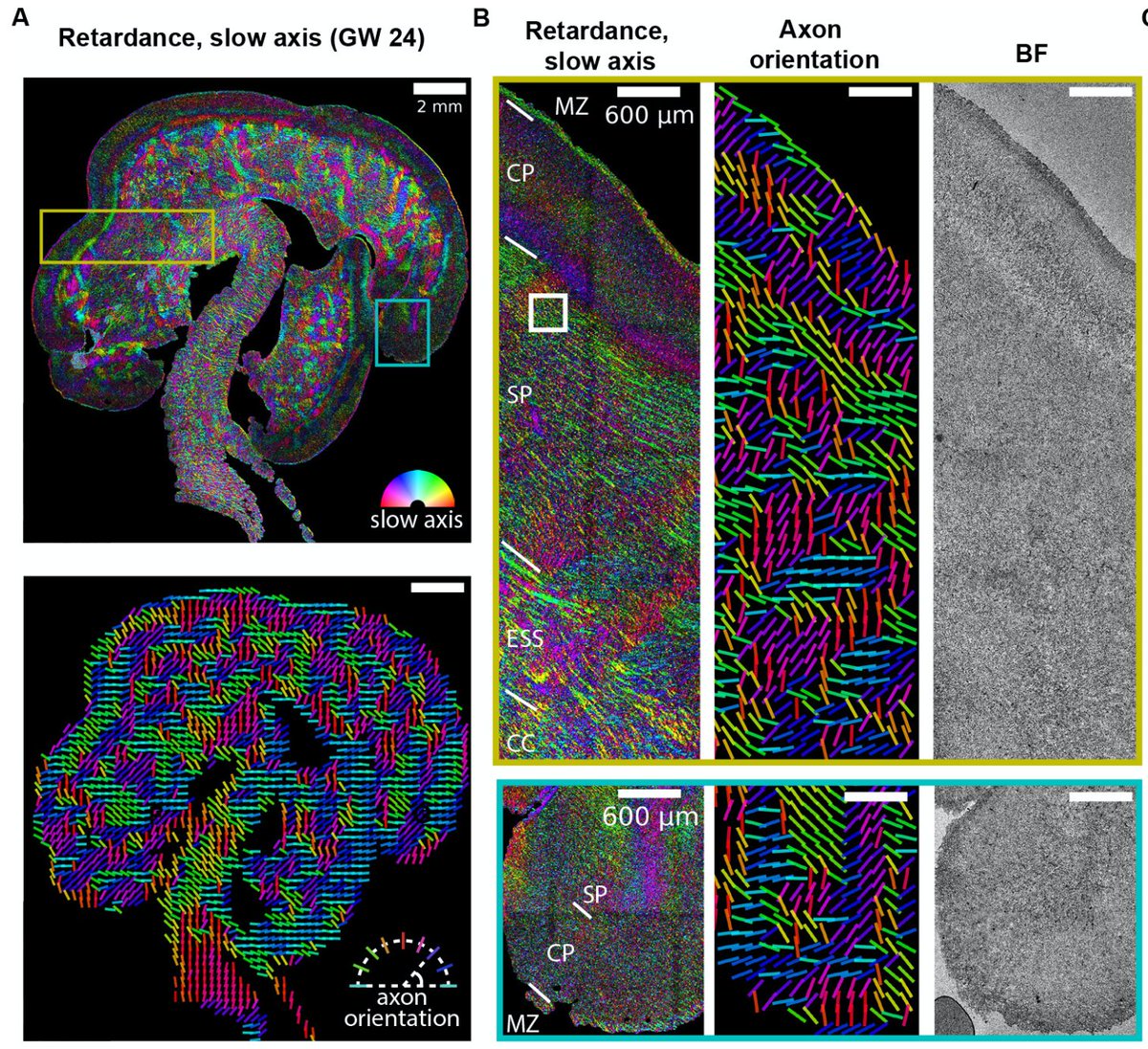 We are excited for the impact this method can have on study of archival brain tissue. Data in collaboration with  @LabNowakowski  https://twitter.com/LabNowakowski/status/1296229354398076928?s=20