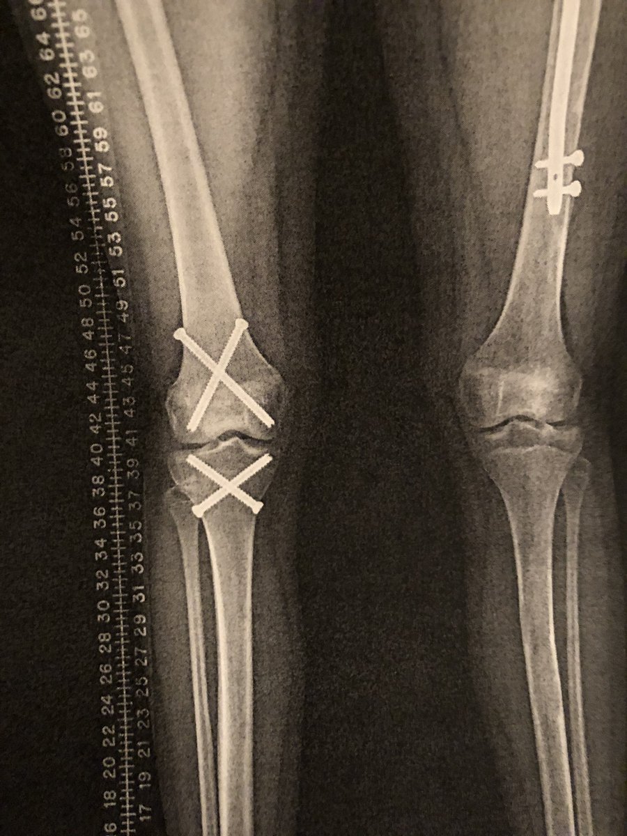LisaBurleson12's tweet photo. Biannual Texas Childrens appointment today. The 4 pesky screws in my daughters leg can come out soon. Will be nice for her to swim without that knee swelling every time. #fibrousdysplasia
#fdysplasia
#rareconnect
#fdssuk
#rarediseases
#fdwarriors
#usaswimming https://t.co/U0j7OQuvOE