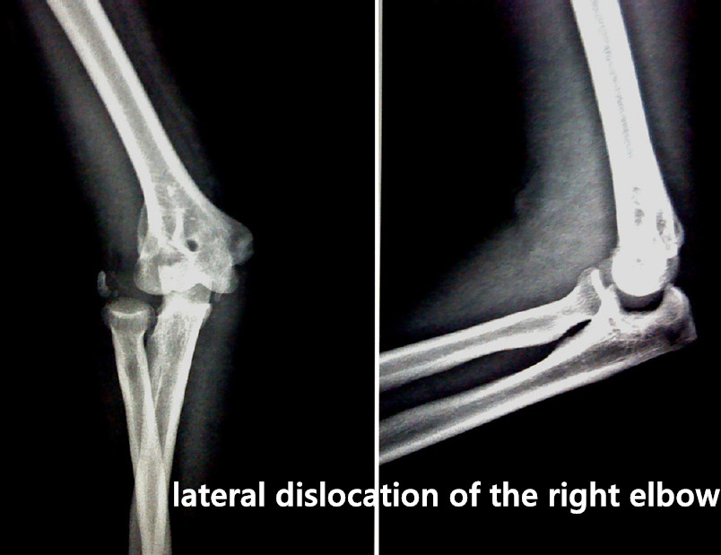ctod_editor's tweet photo. #CTOD [Study Protocol] Lateral dislocation of the elbow: a report of two cases and literature review
#elbow #dislocation

https://t.co/YR9Tp3DMPR https://t.co/1Nf2WMOEvz