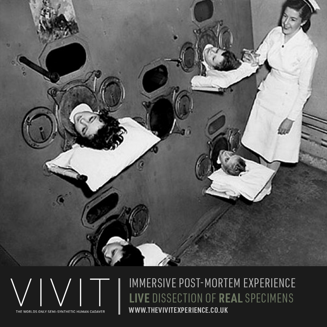 Wow - a great picture from history!

This photo shows children in an iron lung being treated for polio in 1950's. Around the 1950's, the only treatment for polio was the iron lung which worked to help patients breathing.

thevivitexperience.co.uk 
#history #polio #ScienceMatters