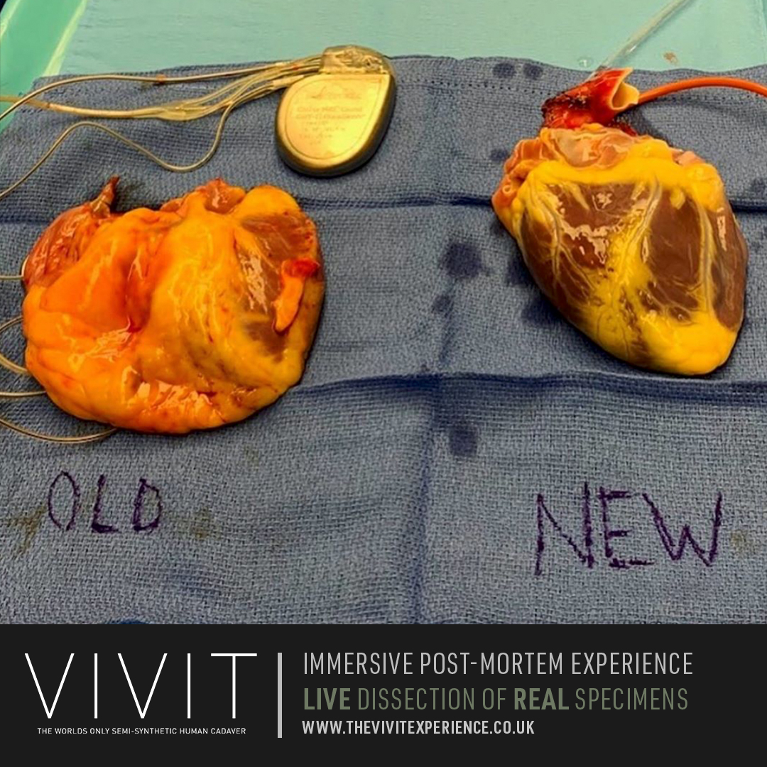 Did you know that around 200 people recieve a heart transplant each year in the UK!

This is a great comparison of an old heart which is diseased, weakened and dilated next to a new heart that is normal in size, lean and muscular. 

thevivitexperience.co.uk
#heart #ScienceMatters