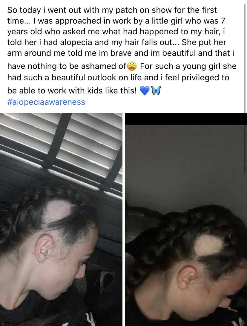 elliemaeob1's tweet image. #Alopecia #alopeiaareata #alopeciaawareness 💙🦋💙