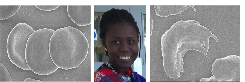 IBERSBioHealth's tweet photo. Take a bow Dr. Olayemi Adeniyi for her work on "“Isolation and characterisation of a potent anti-sickle cell anaemia agent from the Nigerian shrub, Alchornea". @IBERSbio #TheMur https://t.co/oQmBq4CbBm