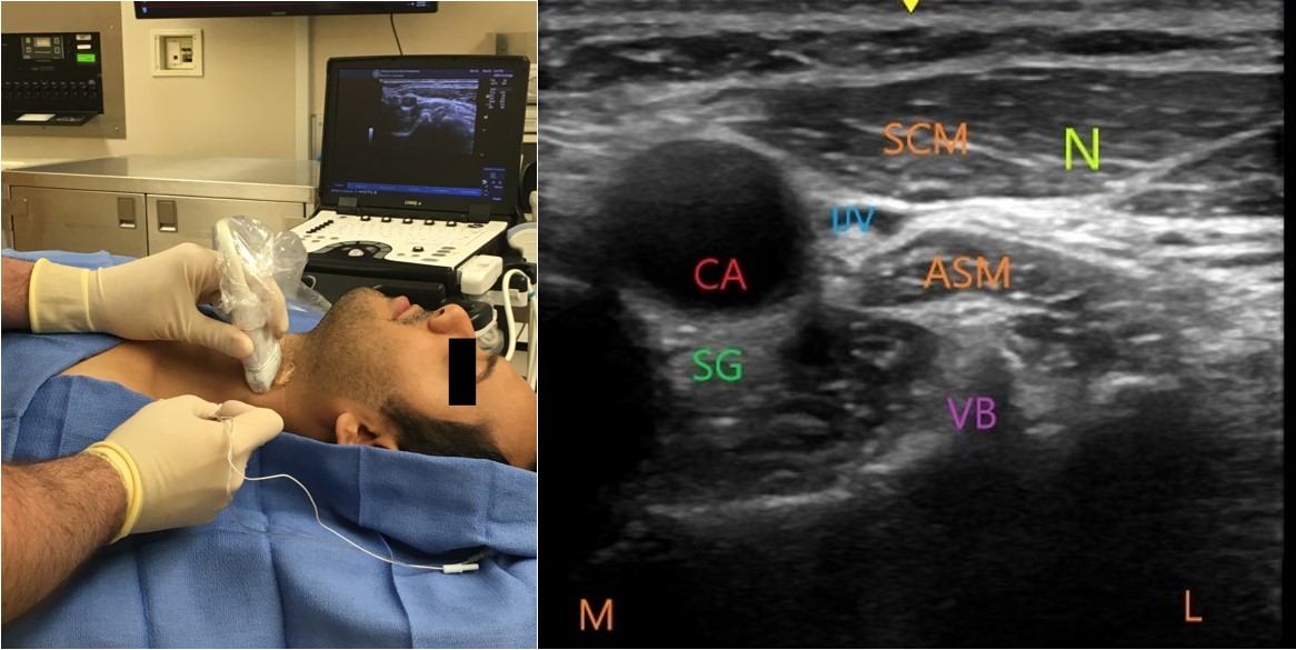hcmcEM's tweet photo. In refractory vfib: stop the catechols! Consider a #BSUS guided left-sided stellate ganglion block #EMconf #FOAMed #CriticalCare #EMresidency #whyhcmc https://t.co/xwbvVs9OUo