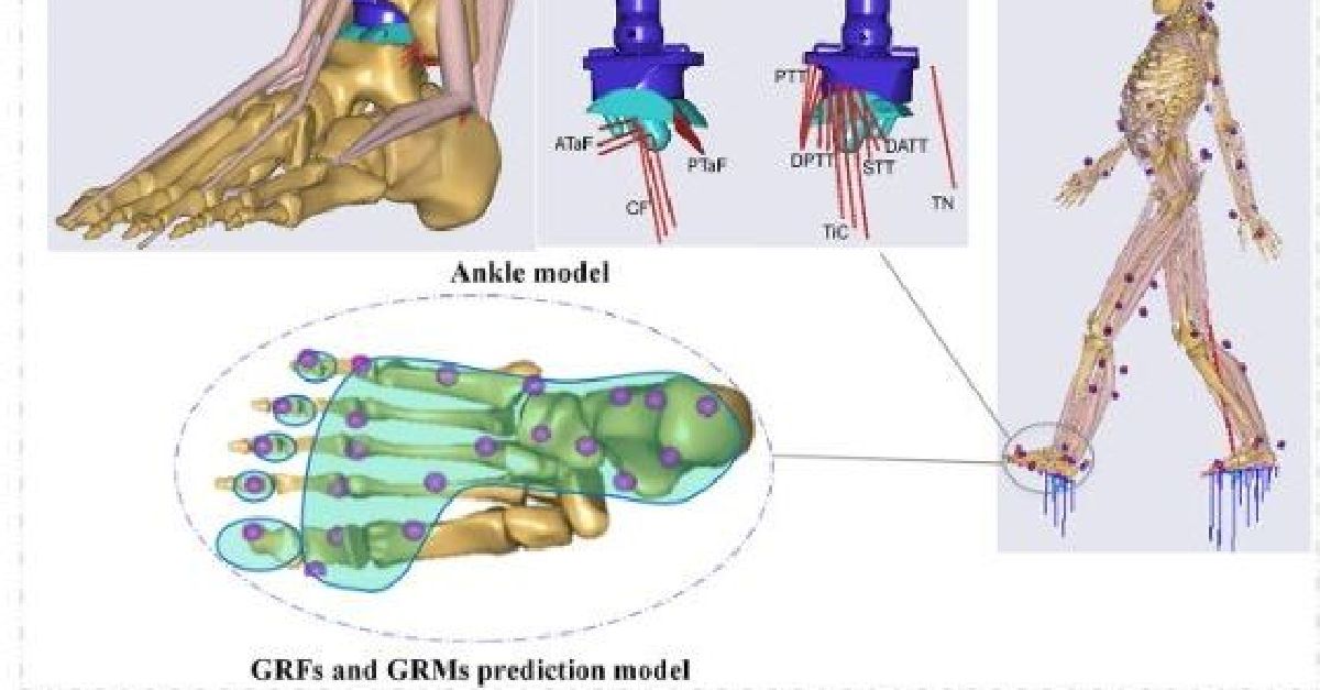 TechAnyBody's tweet image. New study :
&quot;Predicting ground reaction and tibiotalar contact forces after total ankle arthroplasty during walking&quot;
conta.cc/2Ff501Z
#AnyBodyModelingSystem #MultiBodyDynamics #KneeImplants #KneeArthroplasty