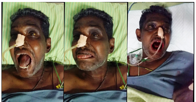 theliverdoc's tweet photo. 1/2
Not all altered behavior in #cirrhosis is #hepatic #encephalopathy. 58yr old, on IV #levofloxacin  #DRUGS for #pneumonia. Spasms of face, arms, tongue lacerations (slurred speech, ER doc says '#disoriented'). Orofaciobrachial #dystonia #fluroquinolone related.
#livertwitter https://t.co/JBFVXDj6Ym