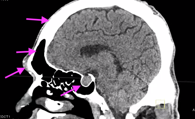 Highlight from today's pituitary conference: Acromegaly manifests in many ways #EndoTwitter

1) pituitary adenoma 2) frontal bossing 3) enlarged frontal sinus 4) thickened calvarium also (not pictured) soft tissue hypertrophy