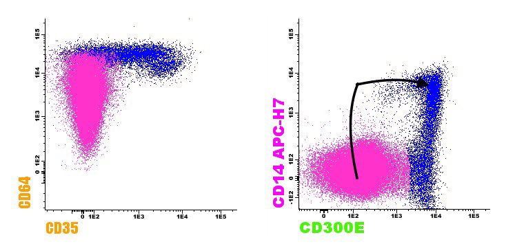 AML with mutated #NPM1, flow cytometry: 🔴 CD34- DR- CD33+high