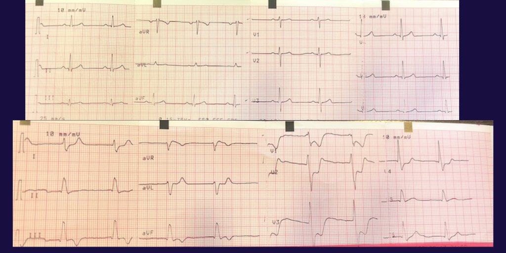 Gonzalo Perez (@gonzaeperez) on Twitter photo 83yo👴#ECGfirst with 10 seconds of difference.
Chest pain and syncope
What do you think? Culprit artery?
<a href="/ShariqShamimMD/">Dr Shariq Shamim</a> <a href="/EM_RESUS/">Sam Ghali, M.D.</a> <a href="/smithECGBlog/">Stephen W. Smith</a> <a href="/ECGQuizzes/">LearnTheHeart ECG</a> <a href="/adribaran/">Adrian Baranchuk MD FACC FRCPC FCCS FSIAC</a> <a href="/ecgrhythms/">Arnel Carmona</a> @ecg_master <a href="/ECGcorner/">ECGcorner</a> <a href="/ECGQuizzes/">LearnTheHeart ECG</a> <a href="/sac_hit/">SAC-HIT</a> <a href="/ElectroSiac/">ElectroSIAC</a> <a href="/SIAC_cardio/">SIAC</a> <a href="/CONAREC_ORG/">CONAREC</a> <a href="/ISE_YCommunity/">ISE Young Community</a> 83yo👴#ECGfirst with 10 seconds of difference.
Chest pain and syncope
What do you think? Culprit artery?
<a href="/ShariqShamimMD/">Dr Shariq Shamim</a> <a href="/EM_RESUS/">Sam Ghali, M.D.</a> <a href="/smithECGBlog/">Stephen W. Smith</a> <a href="/ECGQuizzes/">LearnTheHeart ECG</a> <a href="/adribaran/">Adrian Baranchuk MD FACC FRCPC FCCS FSIAC</a> <a href="/ecgrhythms/">Arnel Carmona</a> @ecg_master <a href="/ECGcorner/">ECGcorner</a> <a href="/ECGQuizzes/">LearnTheHeart ECG</a> <a href="/sac_hit/">SAC-HIT</a> <a href="/ElectroSiac/">ElectroSIAC</a> <a href="/SIAC_cardio/">SIAC</a> <a href="/CONAREC_ORG/">CONAREC</a> <a href="/ISE_YCommunity/">ISE Young Community</a>