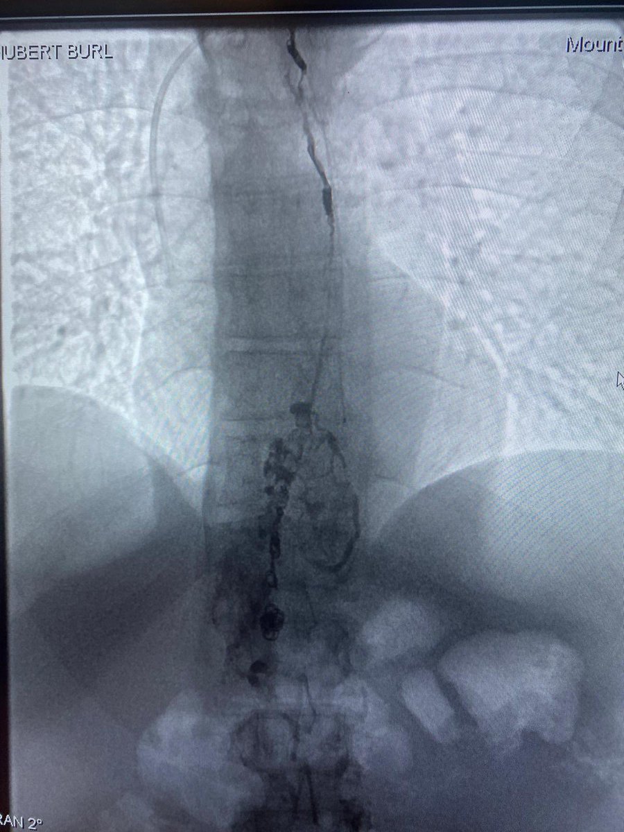 Mike Patel, MD (@mikepatelmd) on Twitter photo 71 y/o w/ hx of pancreatic CA with debilitating recurr chylous ascites tx’d with thoracic duct embo w/ BORALE. <a href="/arzybule/">Adam Zybulewski, MD</a> <a href="/BOlivieriMD/">Brandon Olivieri</a>
Patient returned with minimal ascites on 2 wk f/u.
#Sotradecol #Coil #Glue #nBCA #BORALE #IRad
<a href="/SoFloVIR/">South Florida Vascular Specialists</a> <a href="/SIRRFS/">SIR RFS</a> <a href="/SIRspecialists/">Society of Interventional Radiology</a> <a href="/MSMCRads/">Miami Beach Radiology</a> 71 y/o w/ hx of pancreatic CA with debilitating recurr chylous ascites tx’d with thoracic duct embo w/ BORALE. <a href="/arzybule/">Adam Zybulewski, MD</a> <a href="/BOlivieriMD/">Brandon Olivieri</a>
Patient returned with minimal ascites on 2 wk f/u.
#Sotradecol #Coil #Glue #nBCA #BORALE #IRad
<a href="/SoFloVIR/">South Florida Vascular Specialists</a> <a href="/SIRRFS/">SIR RFS</a> <a href="/SIRspecialists/">Society of Interventional Radiology</a> <a href="/MSMCRads/">Miami Beach Radiology</a>