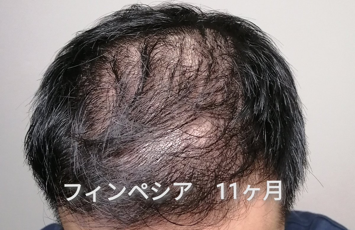 ぐっちん Aga薄毛対策の記録 Guccin Aga Twitter