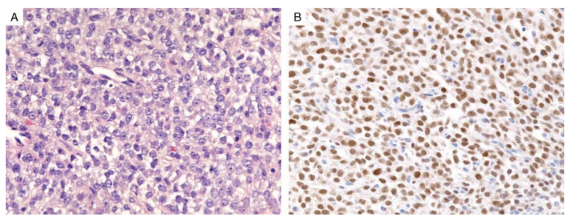 Andrew Bellizzi 🇺🇦 (@ihc_guy) on Twitter photo Next Generation Immunohistochemistry Strikes Again!!!
Kudos to Dr. Charville's Team!!!
DDIT3 Immunohistochemistry Is a Useful Tool for the... : The American Journal of Surgical Pathology journals.lww.com/ajsp/Fulltext/…
<a href="/JMGardnerMD/">Jerad Gardner, MD</a> <a href="/MArnold_PedPath/">Michael Arnold, MD, PhD</a> <a href="/sanamloghavi/">Sanam Loghavi, MD صنم لغوی 🔬🧬</a> <a href="/DennisOMalleyMD/">Dennis P. O'Malley, MD</a> Next Generation Immunohistochemistry Strikes Again!!!
Kudos to Dr. Charville's Team!!!
DDIT3 Immunohistochemistry Is a Useful Tool for the... : The American Journal of Surgical Pathology journals.lww.com/ajsp/Fulltext/…
<a href="/JMGardnerMD/">Jerad Gardner, MD</a> <a href="/MArnold_PedPath/">Michael Arnold, MD, PhD</a> <a href="/sanamloghavi/">Sanam Loghavi, MD صنم لغوی 🔬🧬</a> <a href="/DennisOMalleyMD/">Dennis P. O'Malley, MD</a>