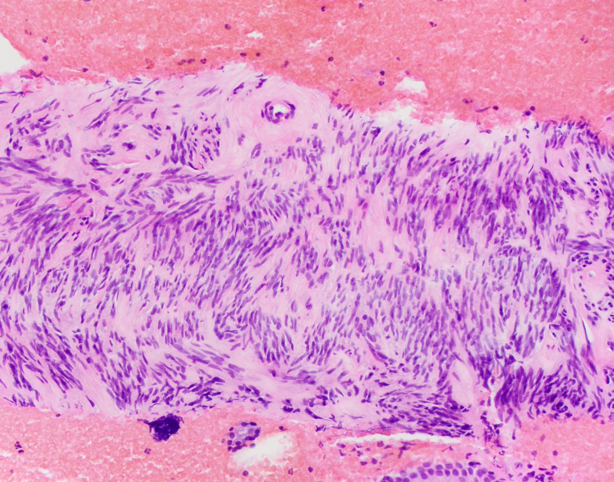 HubertLauMD's tweet image. 3 cm gastric body mass. Differential diagnosis? #IHCpath? #GIpath #FNApath #Cytopath