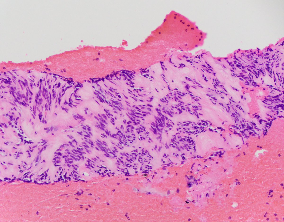 HubertLauMD's tweet image. 3 cm gastric body mass. Differential diagnosis? #IHCpath? #GIpath #FNApath #Cytopath
