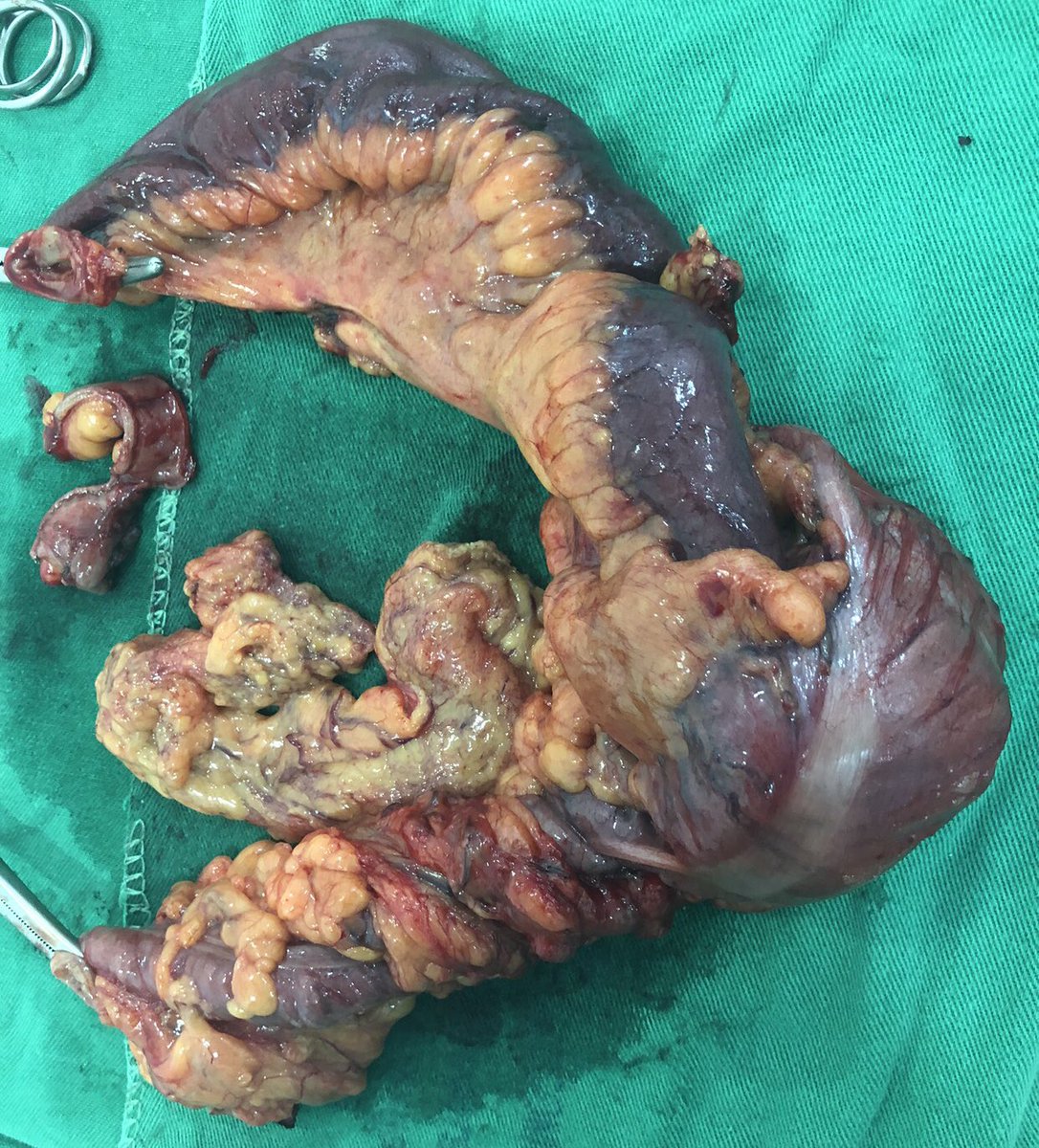 Cirugía General UIS (@cirugiauis) on Twitter photo How frequent is invagination at the level of the ileocecal valve in adults? What is the cause? <a href="/PipeCabreraV/">Dr Luis Felipe Cabrera Vargas MD FACS MACC MACCVA</a> <a href="/CirugiaU/">Cirugía Fundamental</a> <a href="/FelacOficial/">Felac</a> <a href="/Me4Education/">SoMe4SurgicalEducation</a> <a href="/almagoch/">Alberto</a> <a href="/Cirugiaunilibre/">Cirugía General • Unilibre</a> <a href="/MISIRG1/">MISIRG</a> How frequent is invagination at the level of the ileocecal valve in adults? What is the cause? <a href="/PipeCabreraV/">Dr Luis Felipe Cabrera Vargas MD FACS MACC MACCVA</a> <a href="/CirugiaU/">Cirugía Fundamental</a> <a href="/FelacOficial/">Felac</a> <a href="/Me4Education/">SoMe4SurgicalEducation</a> <a href="/almagoch/">Alberto</a> <a href="/Cirugiaunilibre/">Cirugía General • Unilibre</a> <a href="/MISIRG1/">MISIRG</a>