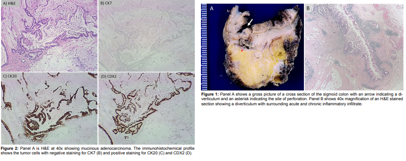 PLMOJ1's tweet photo. Invasive Moderately-Differentiated Mucinous Adenocarcinoma Incidentally Identified in Perforated Acute Diverticulitis With Abscess Formation
Article Link: https://t.co/0NuC3LYiBj
#Colorectal #Adenocarcinoma #Diverticulitis #Perforation #PericolicAbscess #Pathology https://t.co/G26YtemYst