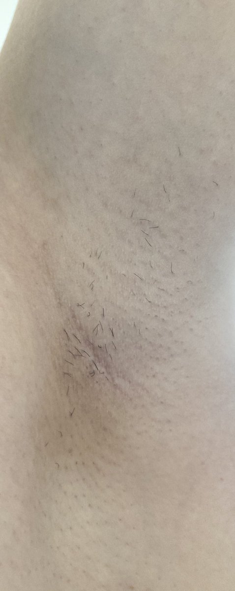 ぷりん エミナル湘南紹介します 一回目の施術から一週間経ちました 経過こんな感じ 膝下と脇 無加工なので汚くてごめんなさいね 脇はぽろぽろ抜けるけど膝下はぽろぽろ取れる感は無いかな 気付いてないだけで抜けてるのかもしれないけど