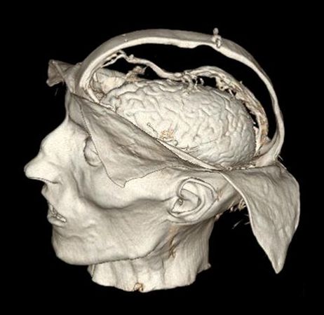 [4/5] Allegedly some of these anatomists were still resenting the academic world for not letting them in, when they died.But today there's no real "mystery" anymore: historians and paleoanthropologists have been able to unearth most of their methods.