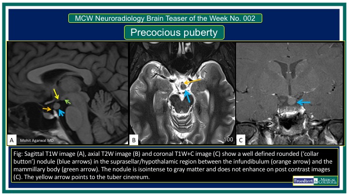 PublishedXPrime's tweet photo. #MCWNeuroradBTW 002 Answers: Hypothalamic/tuber cinereum hamartoma.

Check out the cool labeled 3rd Vent anatomy!

Big thanks to those who participated 

@RGovindiah  @Jaswal_Shama @dr_srikantnalla @drvenki_143  

#FOAMed #FOAMrad #radres #MedEd #RadEd #neurotwitter #NeuroRad https://t.co/ipL4621B5m