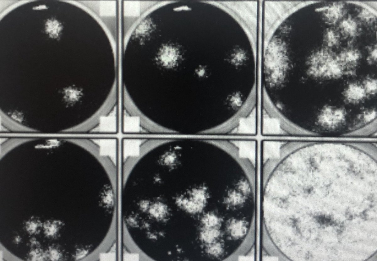 Plaque assays are how we work out how much SARS-COV-2 we have in a sample. And they’re great to illustrate how infections in people work too!