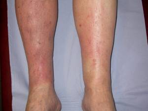 1/ We recently had a patient on service with B/l lower extremity edema with inflammation which was considered to be cellulitis and received antibiotics. This definitely made for some great teaching points as well as a rethink of the Dx. #medtwitter  #MedStudentTwitter  #FOAMed