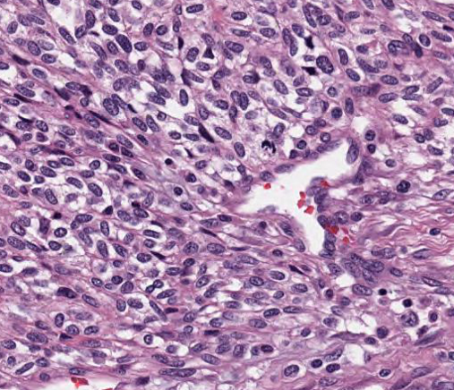 ahmed_bakhshwin's tweet photo. Older female with an antral mass 
@CCFPathRes #GIpath #PathTwitter #pathology #surgpath https://t.co/GxPTVGFrX4