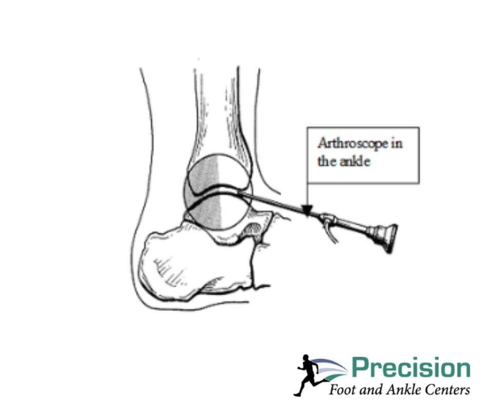 At Precision Foot and Ankle Centers, we use the most advanced technologies to diagnose & treat your foot & ankle conditions. Our expert #podiatrists perform ankle arthroscopy to minimize incision size, risk of infection & recovery time! #anklearthroscopy #anklesurgery #capodiatry