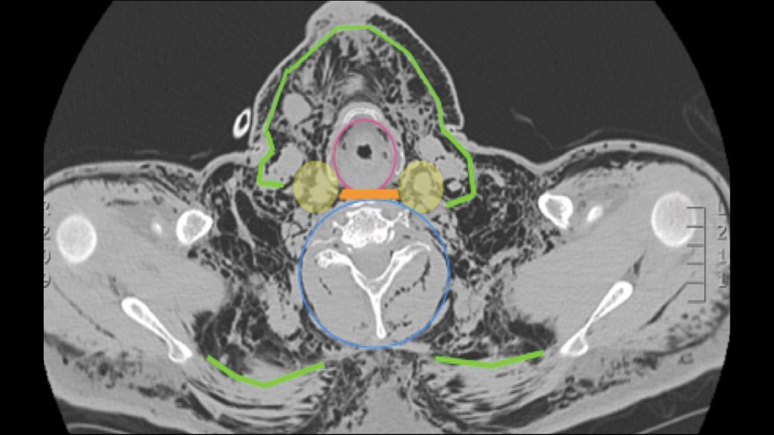 RadioGraphics's tweet photo. This recently published @RadioGraphics imaging assessment of ectopic gas will help you identify its origin and cause and recognize alarm signs associated with severe ectopic gas. Learn more here: https://t.co/DkNxAqjSC3 #RadRes #AbdRad https://t.co/XmVttcEgIG