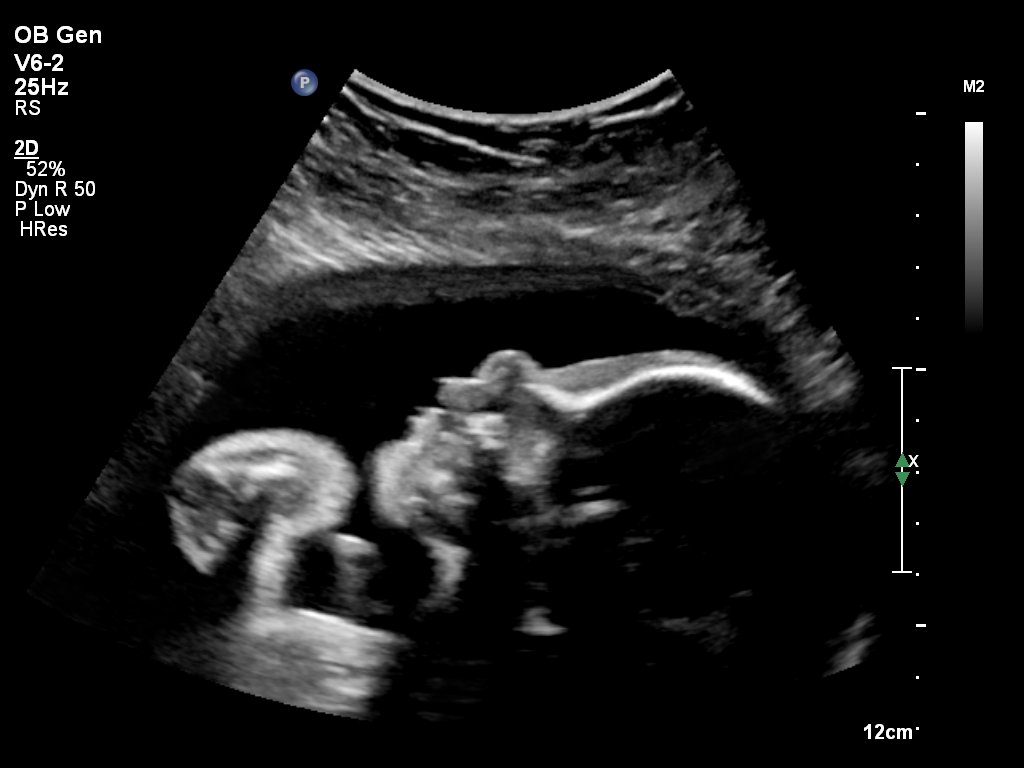 Loveultrasound Twitter Search Loveultrasound Twitter Search