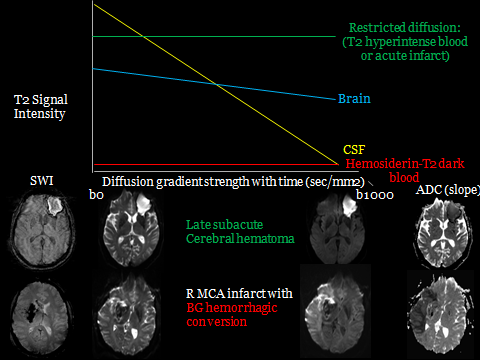 Hammerdongle's tweet photo. DWI/SWI blood physics

T2 bright blood stages will be DWI/SWI bright and diffusion restrict.
T2 dark blood stages will maintain DWI/SWI hypointensity and may obscure areas of ischemic infarct due to hemorrhagic conversion.

#FOAMed #FOAMrad #radres #NeuroRad #radiology #Neurology https://t.co/0i7ZZ3wlzW