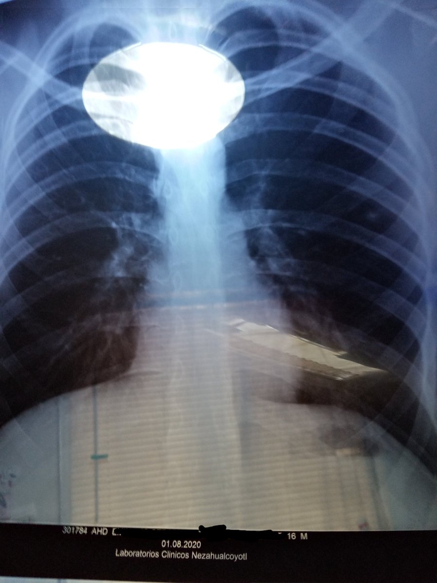 For those who did know, I got COVID-19 two months ago (to me more precise, one week before Gila's debut)Ok, I got my studies some days ago about my lungs.I'll try to explain in a simple way the symptoms so you can make some precautions and my experience with it.