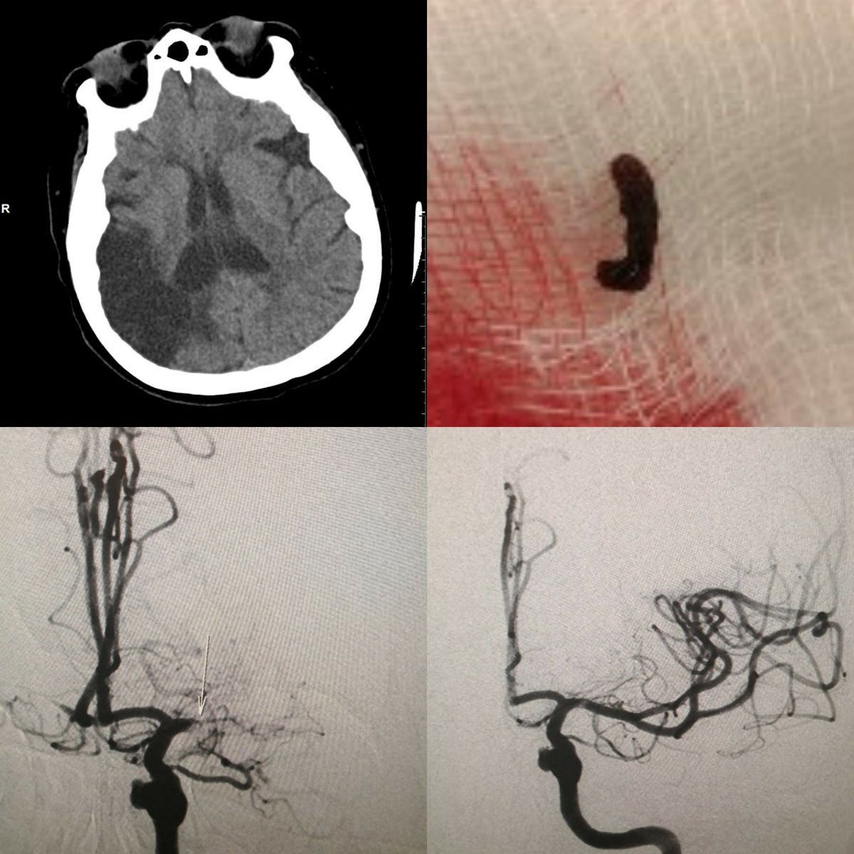 SuspectedLVO's tweet image. Behind every stroke is a story. She is mRS 5 at baseline (left hemiplegia), but who are we to judge others' quality of life? She could talk, smile and kiss her husband, how do you not treat her? Who cares about your "mRS 0-2" statistics, it's all about the patient. Always