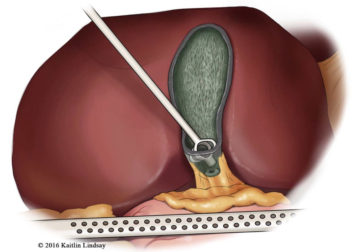 Amazing guide by @DissanaikeMD how to perform a step-by-step Laparoscopic Subtotal Fenestrating Cholecystectomy as a bail out in the Difficult Gallbladder . Published by @JAmCollSurg