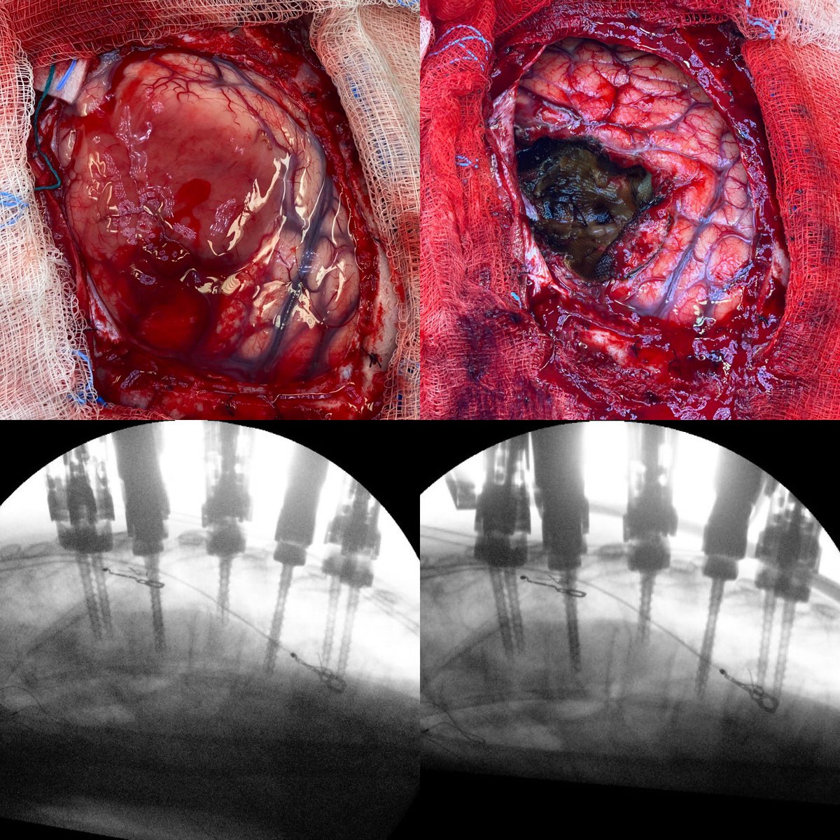 DorisWangLab's tweet photo. Before and after from this fun weekend:
#Neurosurgery #brainsurgery #spinesurgery #braintumor #compressionfracture #nuvasive #MedTwitter #neurosurgeonslife #ilovemyjob https://t.co/MQNVZhAtbU