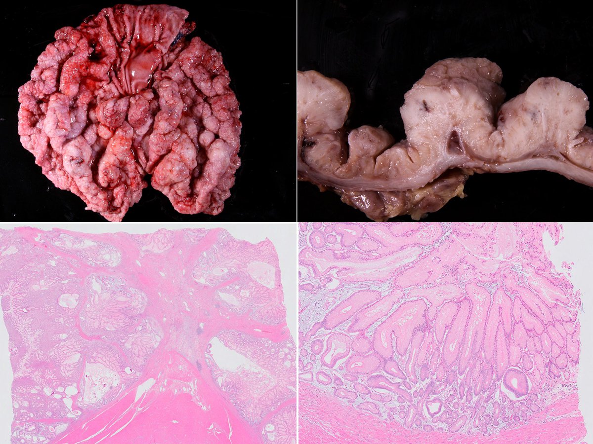 Vikram Deshpande (@vik_deshpandemd) on Twitter photo Here’s a real treat ( courtesy <a href="/ohyilmaz/">Omer Yilmaz</a>)- Menetrier disease. Featuring the most dramatic foveolar hyperplasia I’ve seen! Here’s a real treat ( courtesy <a href="/ohyilmaz/">Omer Yilmaz</a>)- Menetrier disease. Featuring the most dramatic foveolar hyperplasia I’ve seen!