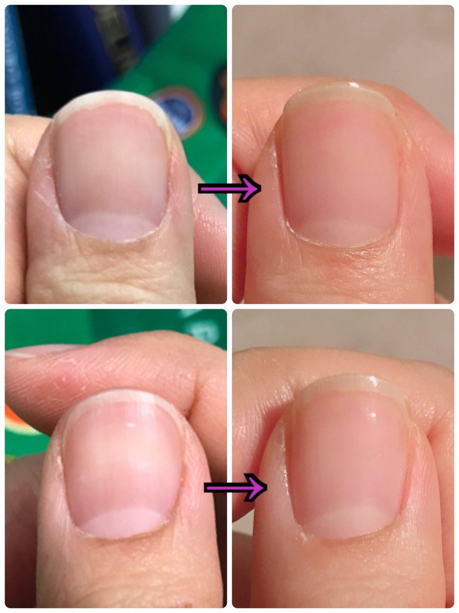 Yu 手の洗いすぎ アルコール消毒のしすぎで剥がれ始めた爪のピンクの部分を救済するのが最近のマイブーム 死語 です