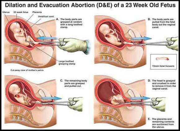 crime 1: abortion.abortion =/= women right.abortion = crime.except in extreme circumstances.
