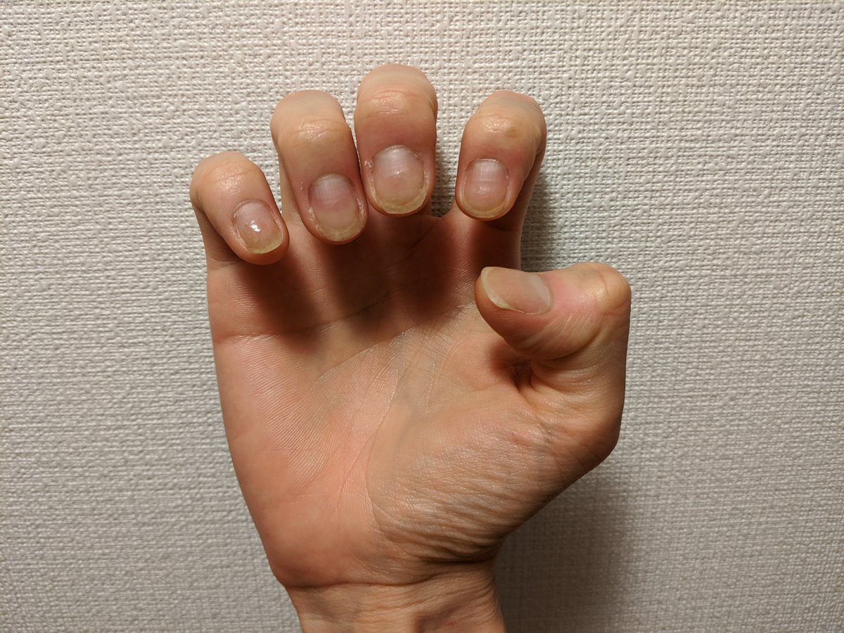 爪噛み男 Nail Biter 162日目 気付いたら伸びてました ベースコートと肉体的に疲れること 噛む時間と気力がない がよかった Day 162 The Long Weekend Passed Nails Grew 爪噛み克服 深爪矯正 Stopnailbiting T Co X5zezriy8r 爪噛み男 Nail Biter 162日目 気付いたら伸びてました ベースコートと肉体的に疲れること 噛む時間と気力がない がよかった Day 162 The Long Weekend Passed Nails Grew 爪噛み克服 深爪矯正 Stopnailbiting T Co X5zezriy8r