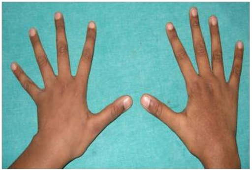 Imagen: Fotografía que muestra unas manos con dedos largos y delgados, un posible síntoma del Síndrome de Marfan.