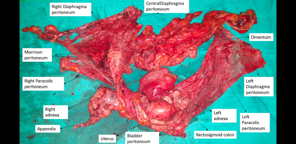 HamdullahSozen's tweet photo. Over kanseri sebepli Retroperitoneal en bloc resection of multivisceral peritoneal packet ameliyatı vaka sayımız son iki hasta ile 40'i aştı. Tüm batin peritonektomi(tümör ile infiltre alanlar)yaptığımız bu hasta grubunda sağkalım sonuçlarını kısa zamanda yayınlamayı planliyoruz https://t.co/Jfsr1KsqN7
