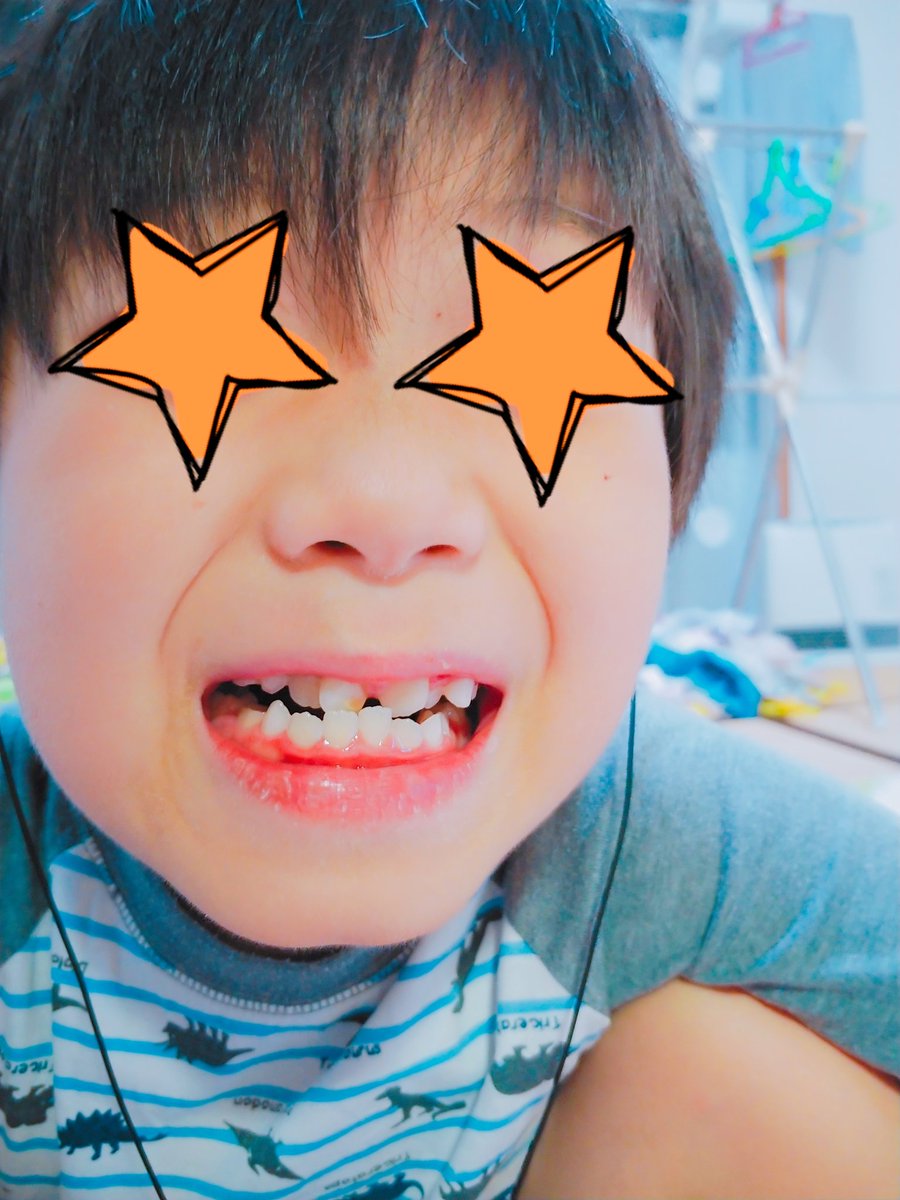 芽夢 Megumu 息子の歯並び 前は下顎かなり出ていて 大掛かりな手術が必要と言われてたけど放置してたら上顎だいぶ成長してて見た目良くなってる 歯並びは相変わらず悪し 身内に歯並び悪い人いないのに