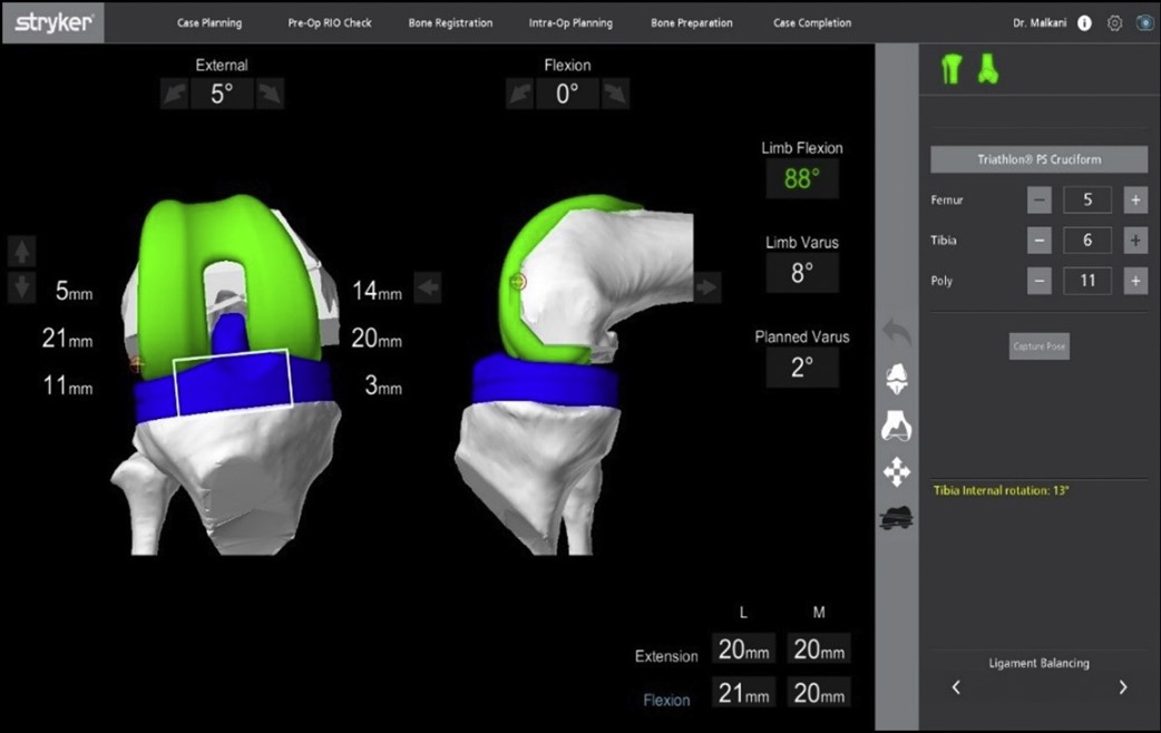 ArthroToday's tweet photo. #OrthoTwitter, considering adopting #RA-TKA? 

This article assists with workflow, operative times, and learning curve. #Tourniquettime <60min (skin==>skin). #Learningcurve <40 cases. @CenterRotation @jointdocShields @NuelleSportsMD @NaanDerthaal 

https://t.co/nGb6MY47bP https://t.co/v8KdaBwhw4