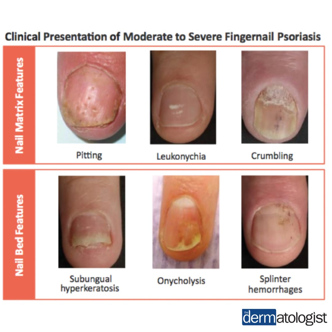 nail crumbling psoriasis