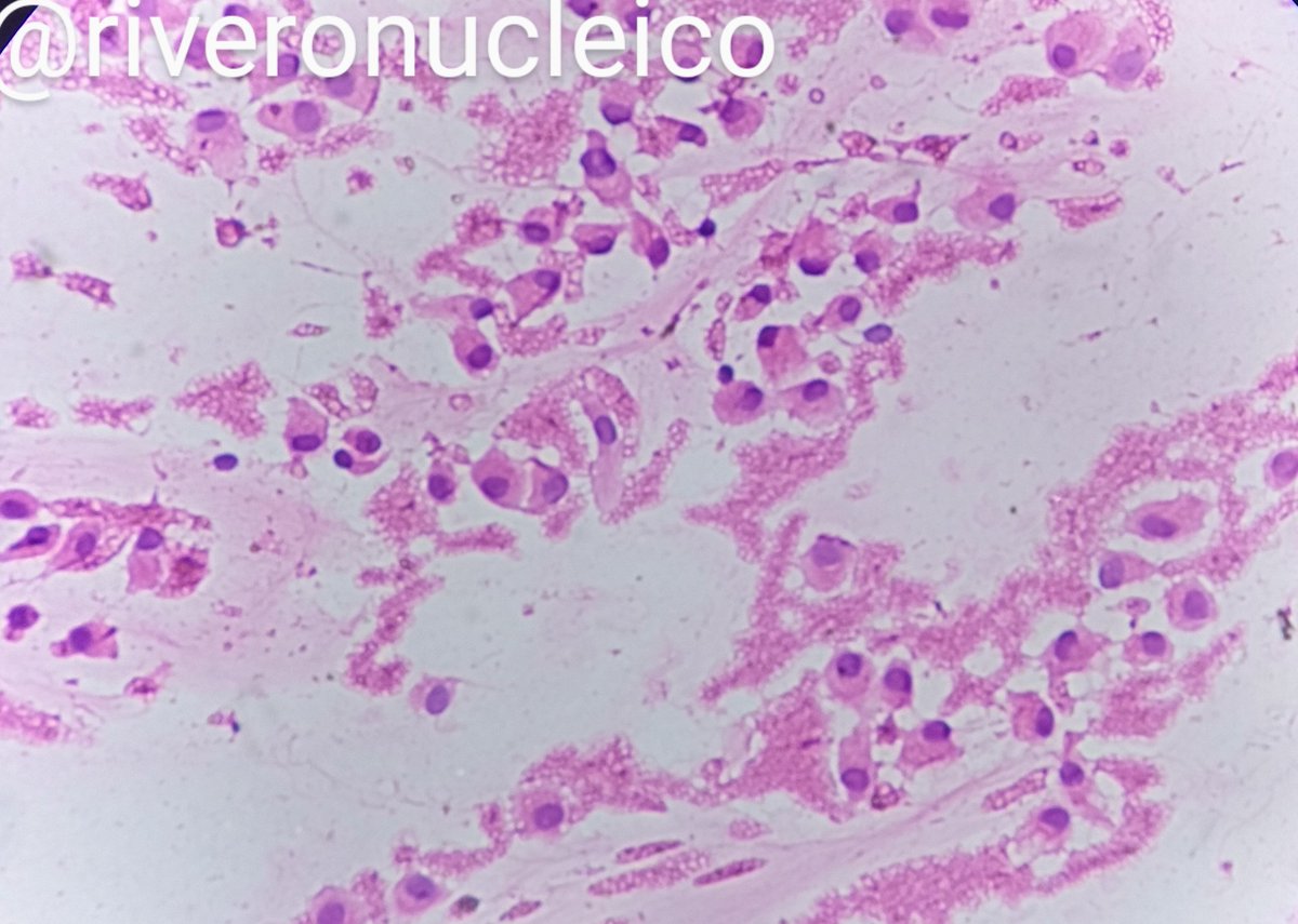 Saúl RM Path (@saul_path) on Twitter photo Lots of mucin. On the spread, the mucin looks like oatmeal paste.
FNA Mucinous carcinoma of the breast.
DQ and H&E stains.
<a href="/oscar5raigo/">Oscar Raigosa García</a> <a href="/slac2020/">SLAC - XXX Congreso 2021, Cartagena</a> <a href="/SLAPpatologia/">SLAP Patología</a> <a href="/IACytology/">International Academy Cytology</a> #cytology #breastcancer #breastpath <a href="/asocolpat/">Asociación Colombiana de Patología - Asocolpat</a> Lots of mucin. On the spread, the mucin looks like oatmeal paste.
FNA Mucinous carcinoma of the breast.
DQ and H&E stains.
<a href="/oscar5raigo/">Oscar Raigosa García</a> <a href="/slac2020/">SLAC - XXX Congreso 2021, Cartagena</a> <a href="/SLAPpatologia/">SLAP Patología</a> <a href="/IACytology/">International Academy Cytology</a> #cytology #breastcancer #breastpath <a href="/asocolpat/">Asociación Colombiana de Patología - Asocolpat</a>
