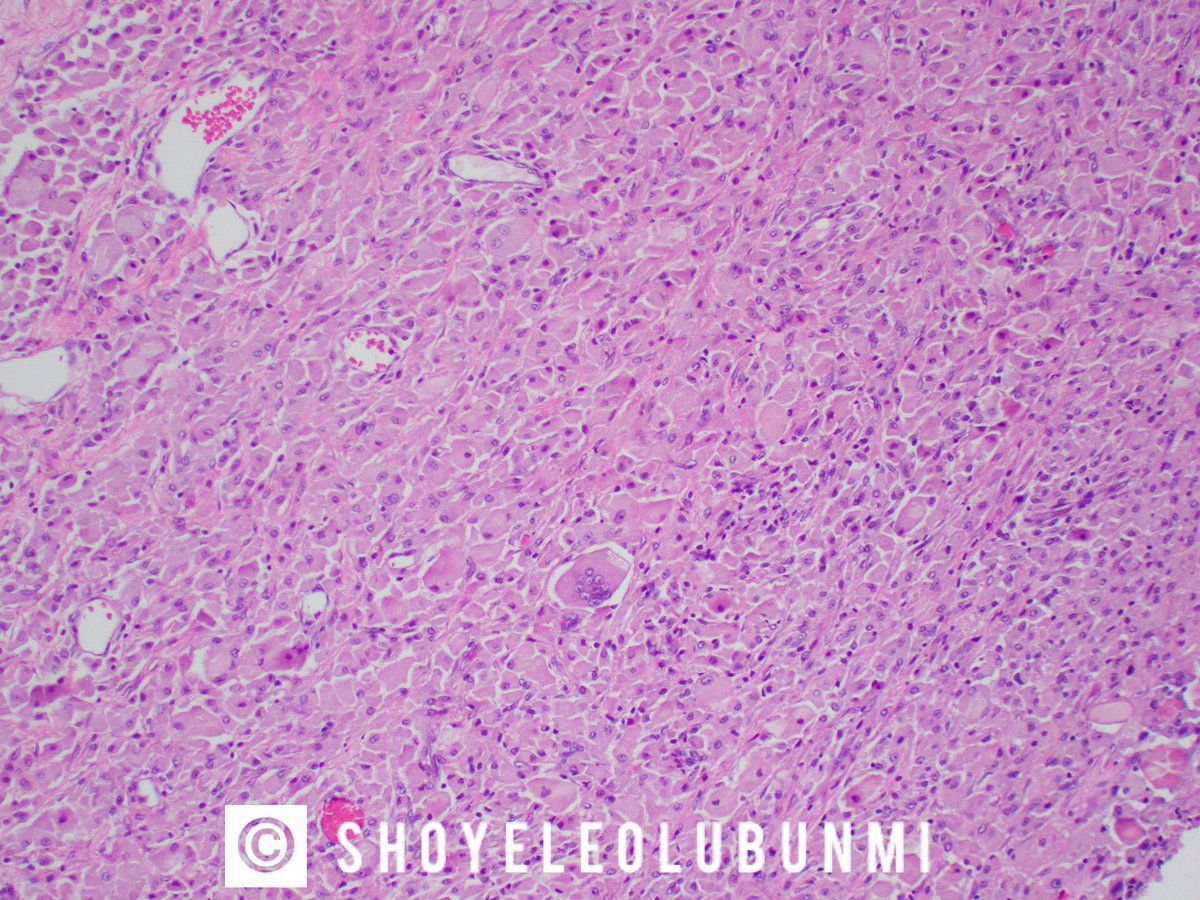 ShoyeleOlubunmi's tweet photo. #PathPourri
Case 4: Middle-aged patient, uterus/ endometrium.
Benign or malignant?
Would you perform stains? https://t.co/KESJ929Wfm