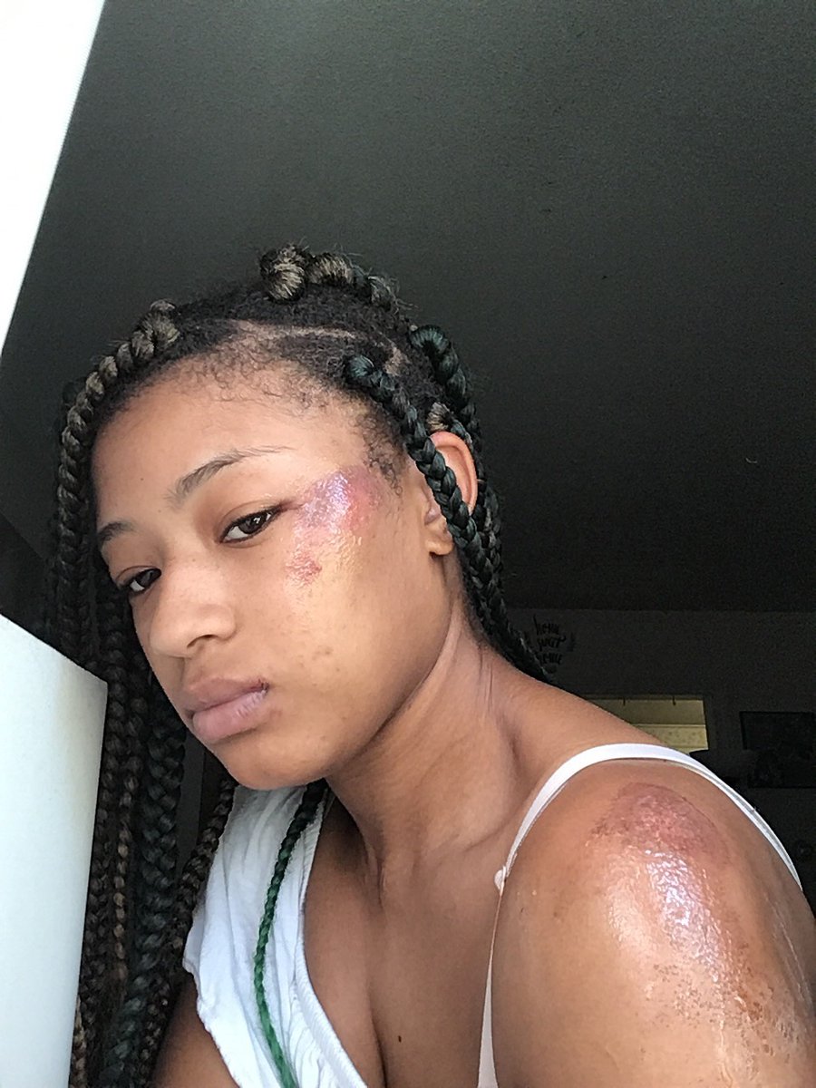 DaMonkeyBaby's tweet photo. My so called friends left me for dead in Stamford last night after a brunch date.... I legit woke up in Stamford hospital to restraints and bandaids where I was injected with morphine to put me to sleep. And still No one has answers for me smh. Be careful y’all https://t.co/zvuX5irq3Y
